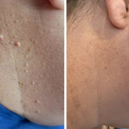 Nova Élimination des Acrochordons