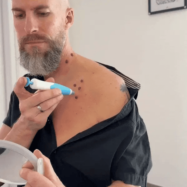 Nova Élimination des Acrochordons