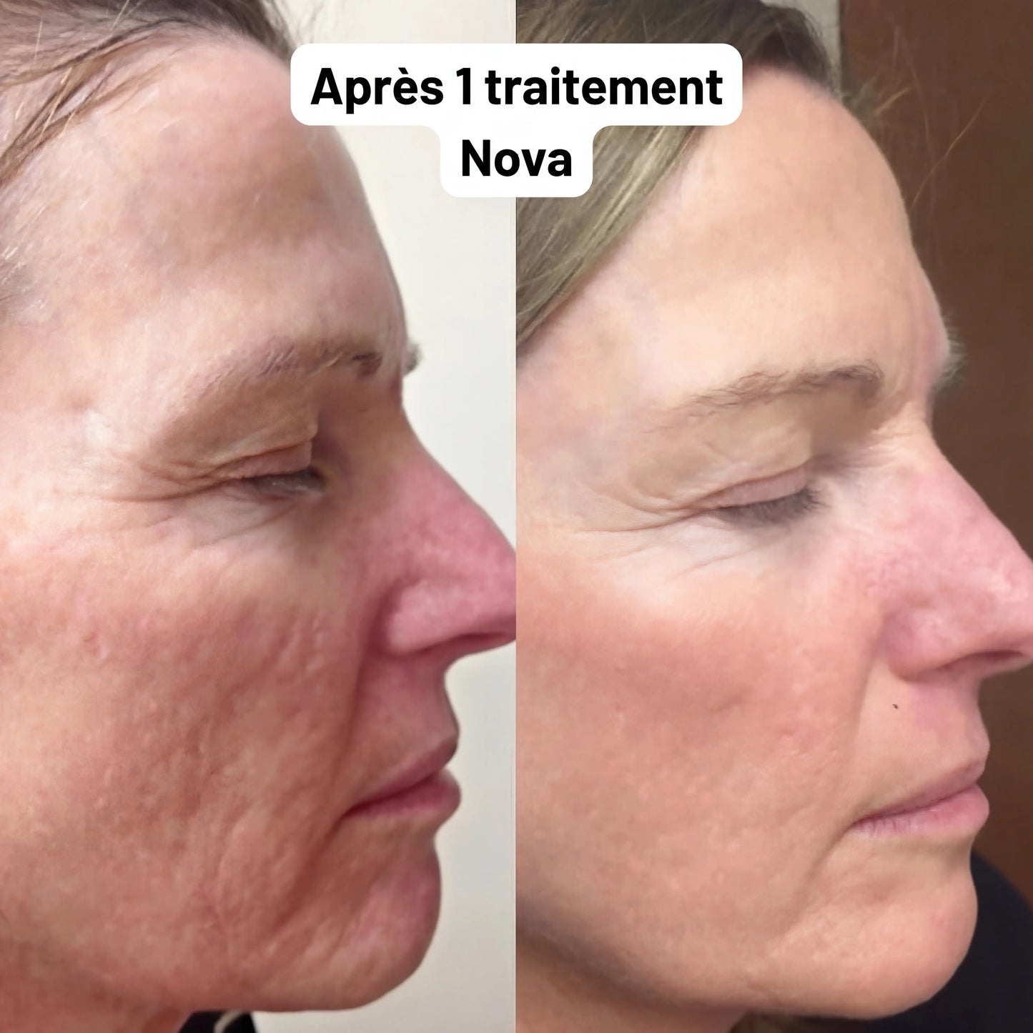 Sistema di microinfusione Nova