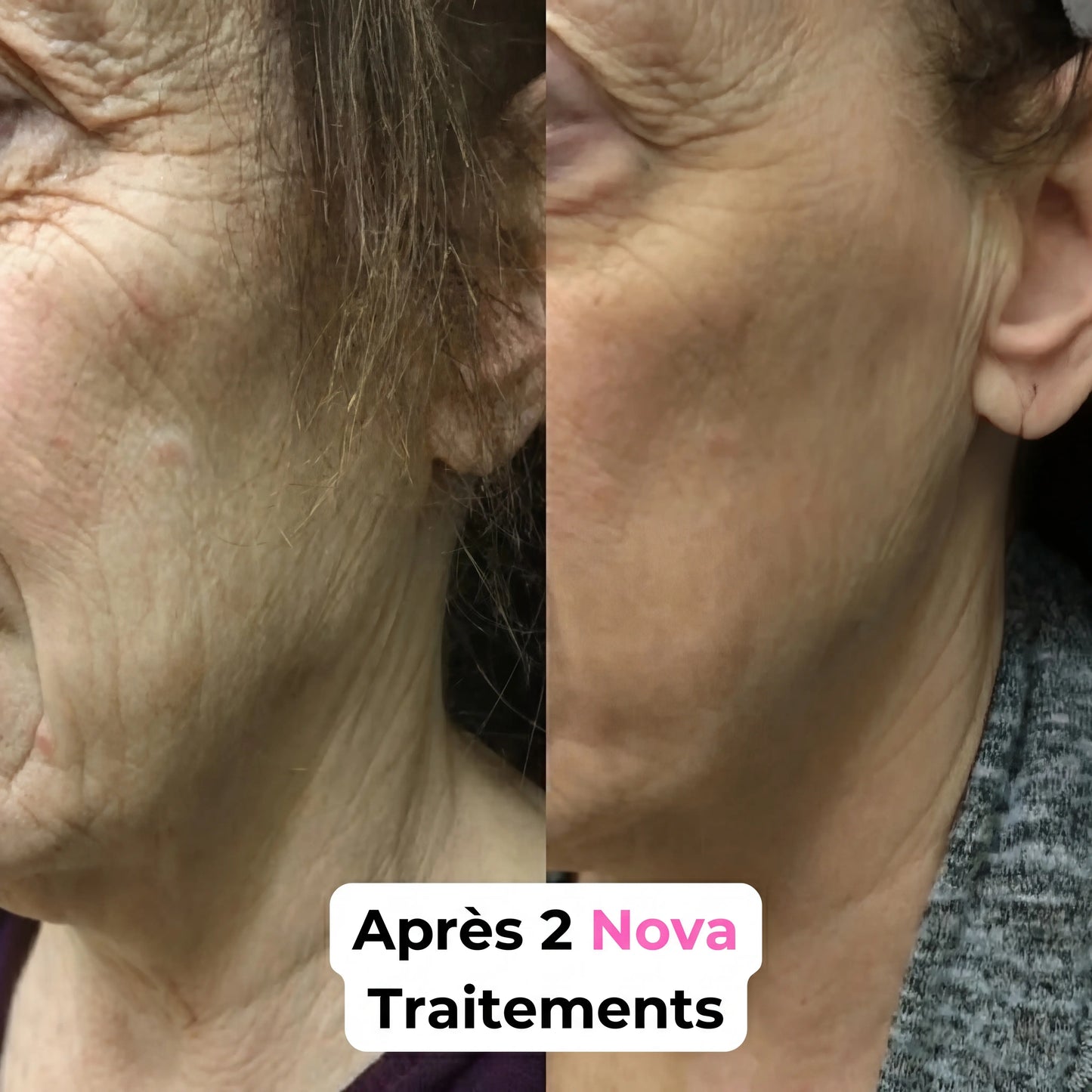 Sistema di microinfusione Nova