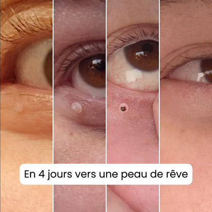 Nova Élimination des Acrochordons