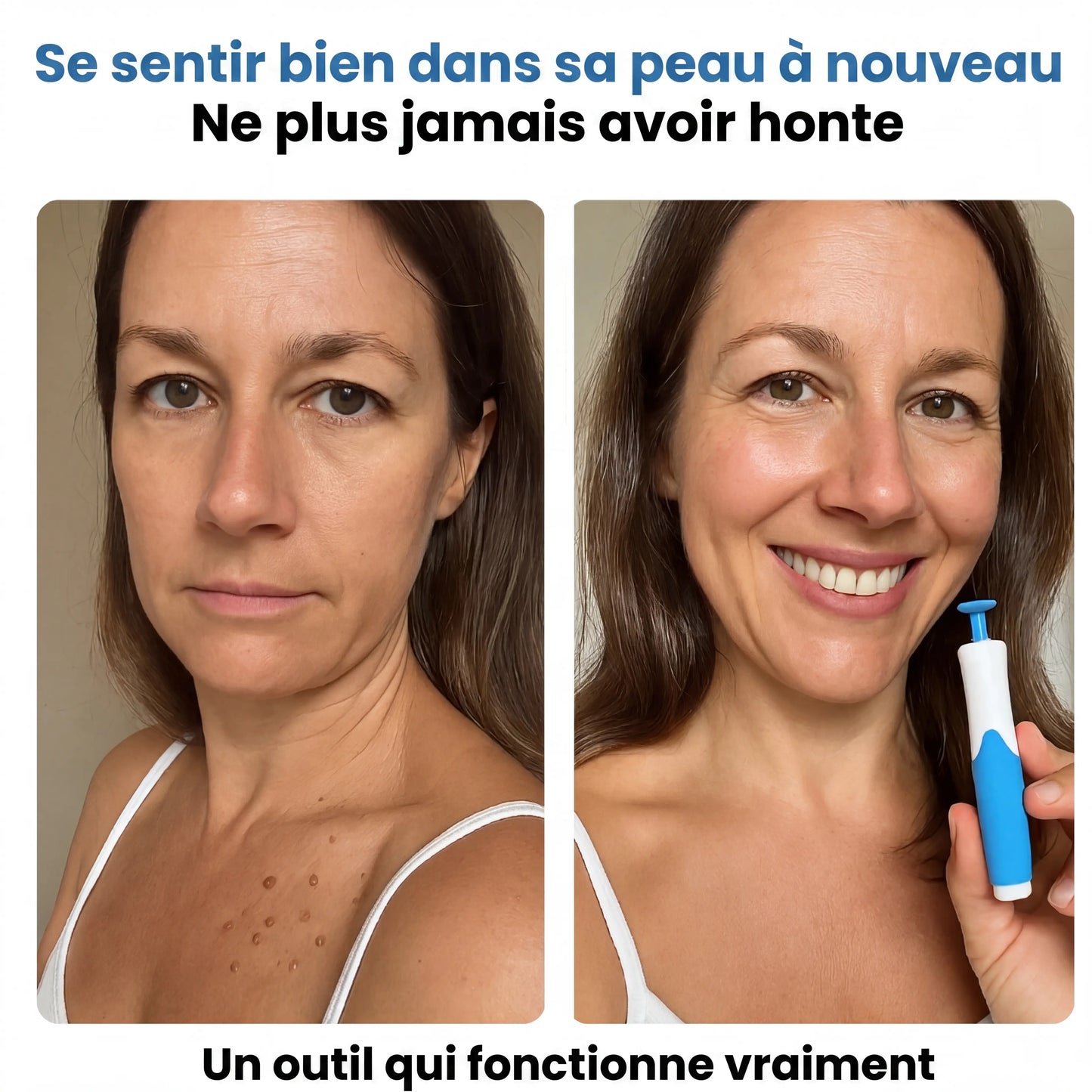 Nova Élimination des Acrochordons